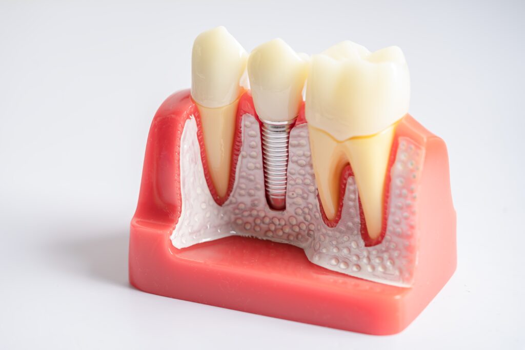 dental implants near me