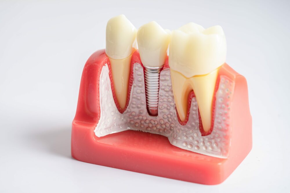 dental implants near me